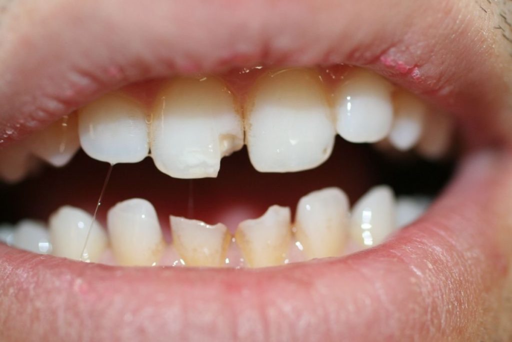 dientes rotos