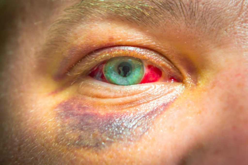 bigstock photo of eye injury place for 290236066